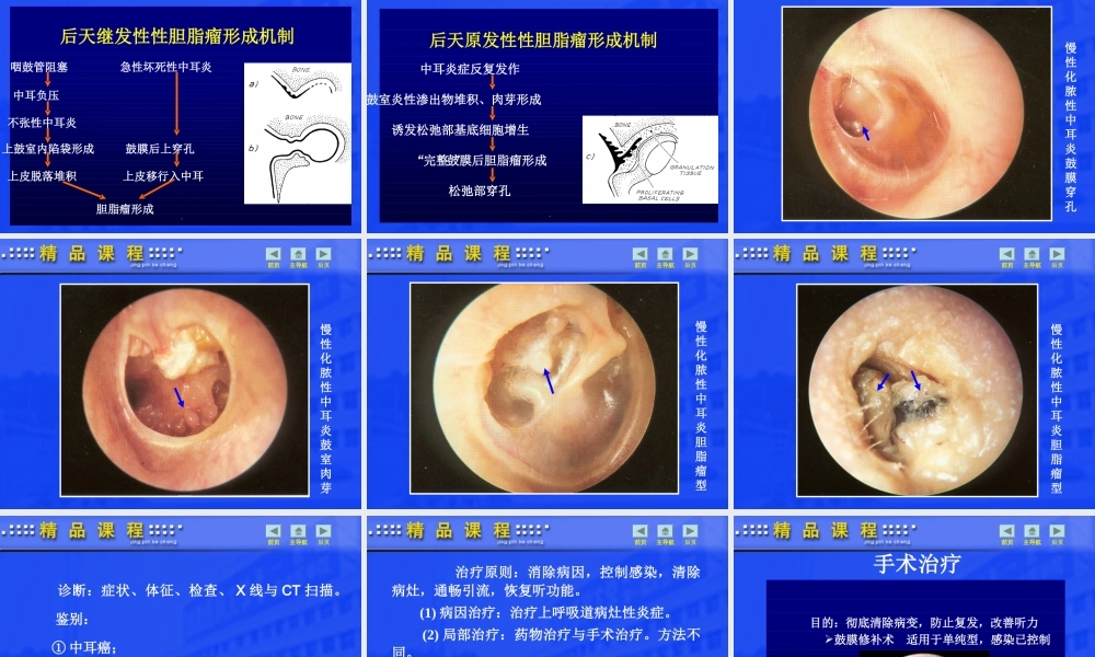 急慢性化脓性中耳炎.ppt
