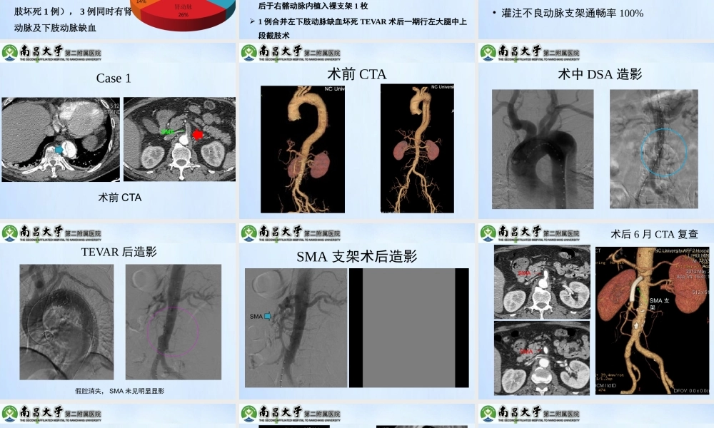 急性Stanford-B型AD并灌注不良的处理.pptx