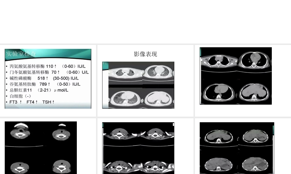 朗格罕斯细胞组织细胞增生症...ppt