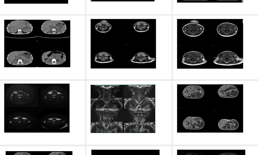 朗格罕斯细胞组织细胞增生症...ppt