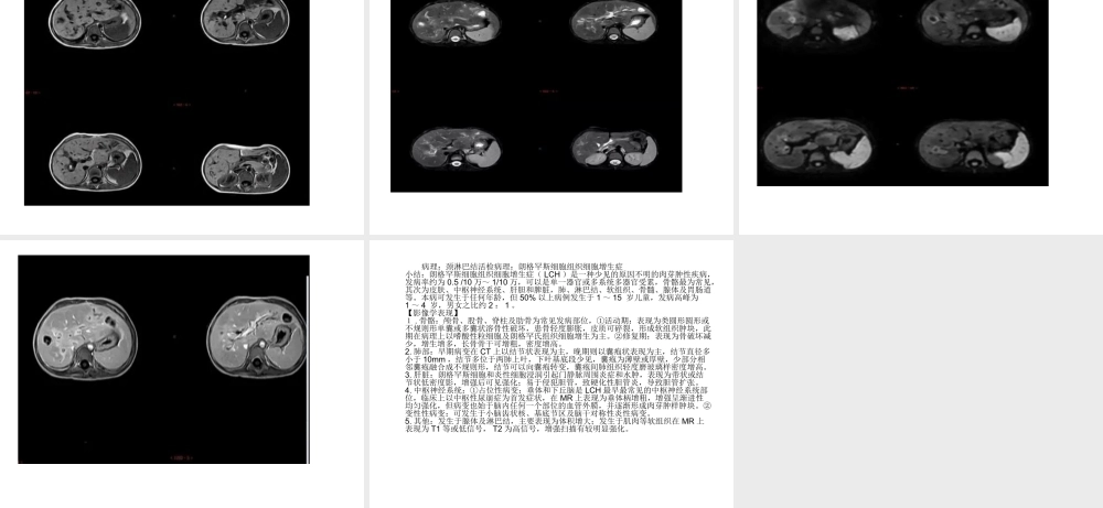 朗格罕斯细胞组织细胞增生症...ppt