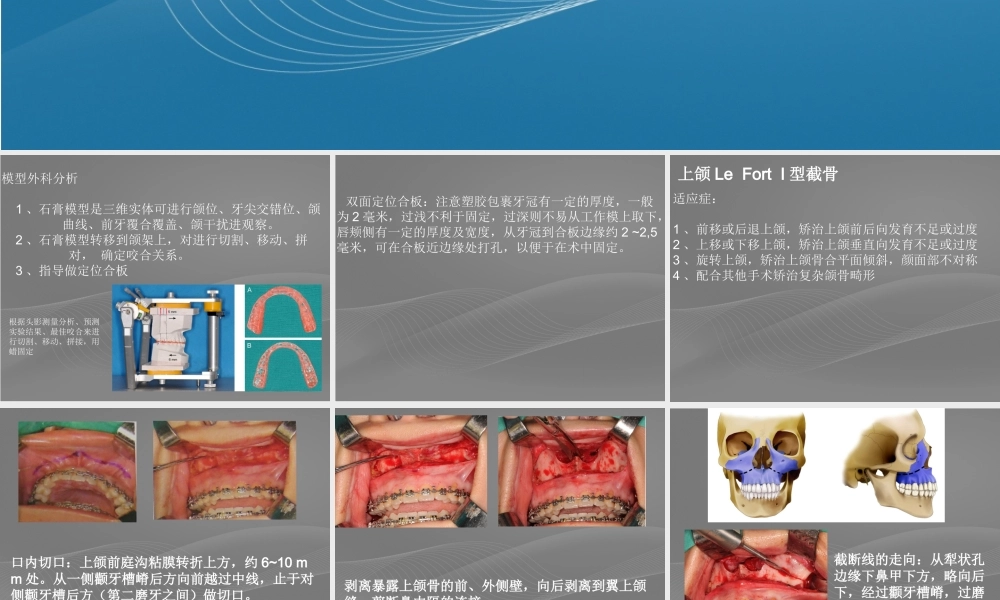 正颌手术.ppt