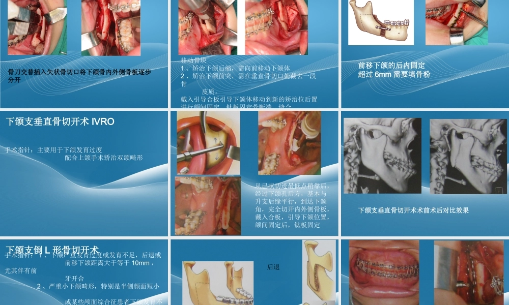 正颌手术.ppt