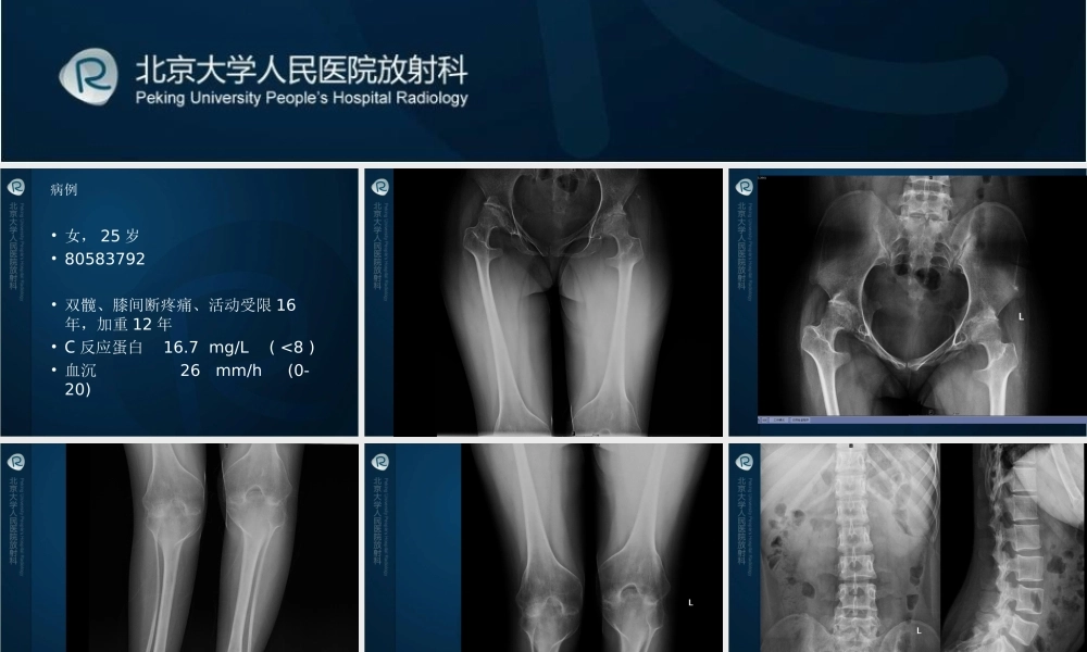 幼年类风湿性关节炎分析.ppt