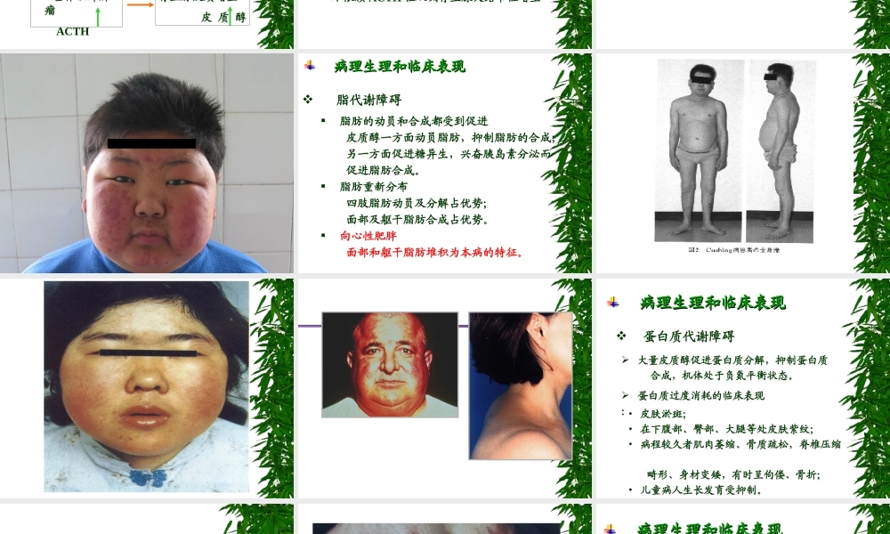 库欣综合征5.ppt