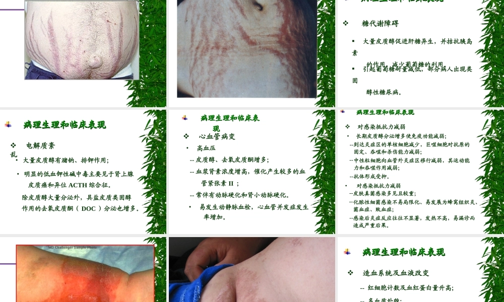 库欣综合征5.ppt