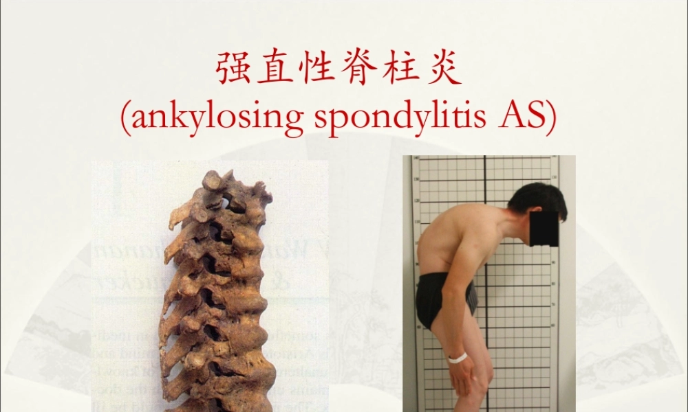 强直性脊柱炎综述.ppt