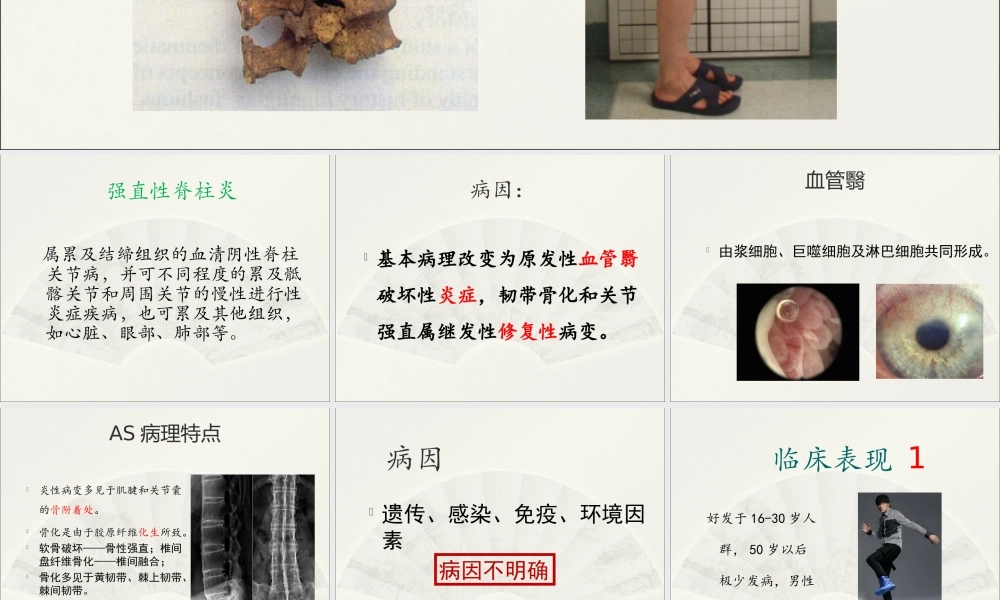 强直性脊柱炎综述.ppt