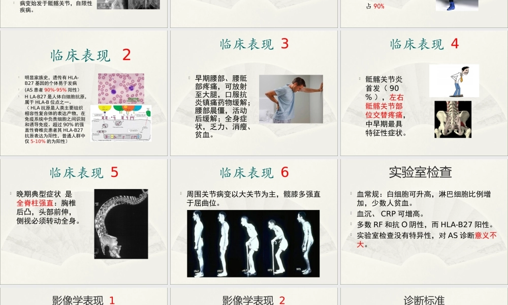 强直性脊柱炎综述.ppt