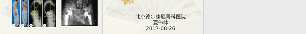 强直性脊柱炎综述.ppt