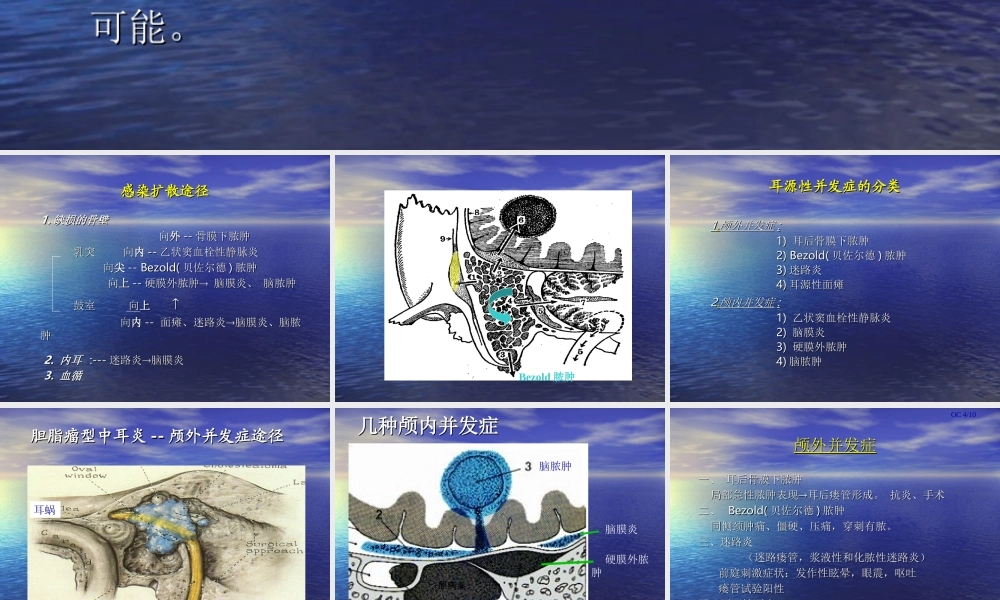 慢性化脓性中耳炎并发症.ppt