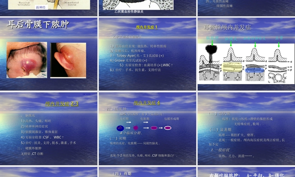 慢性化脓性中耳炎并发症.ppt