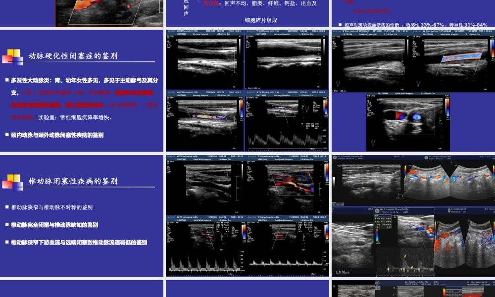 斑块的超声评价及动脉硬化性病变的鉴别.ppt