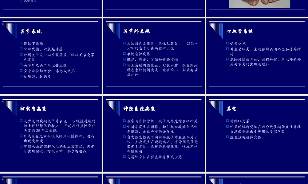 强直性脊柱炎(精).ppt