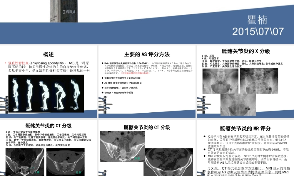 强直性脊柱炎MRI评分.ppt
