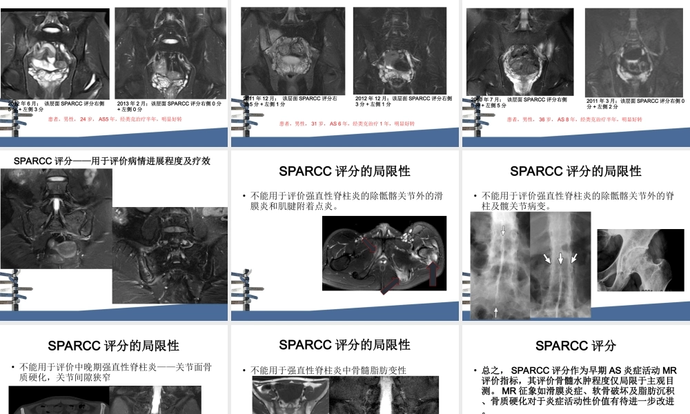 强直性脊柱炎MRI评分.ppt