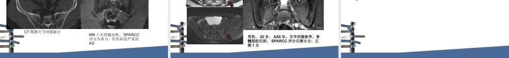强直性脊柱炎MRI评分.ppt