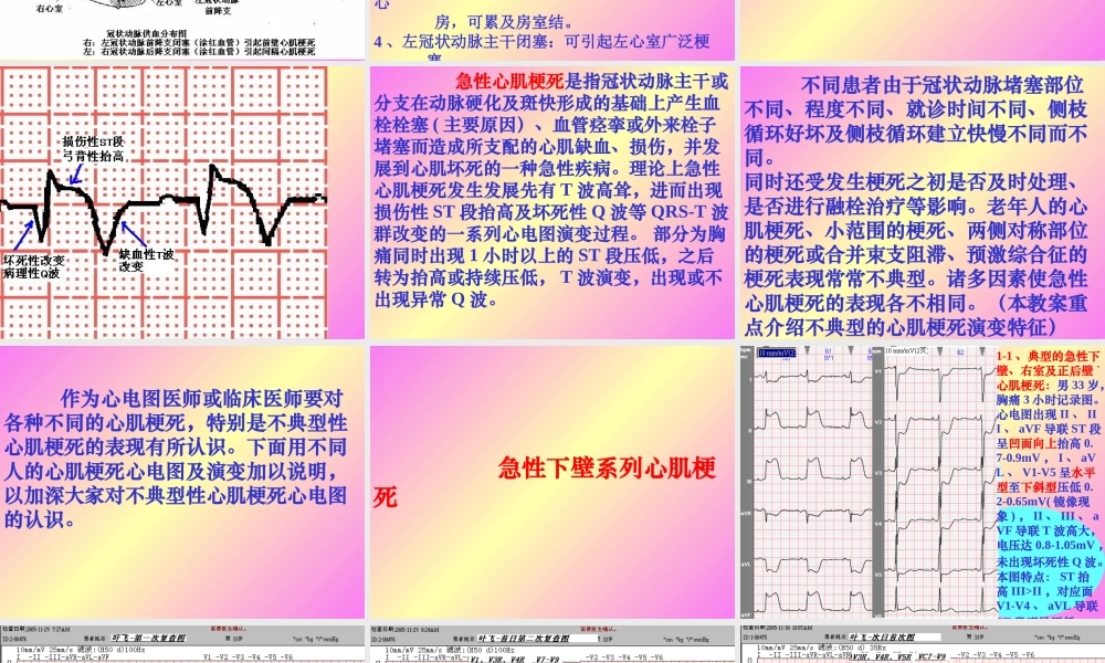 急性心肌梗死心电图演变.ppt