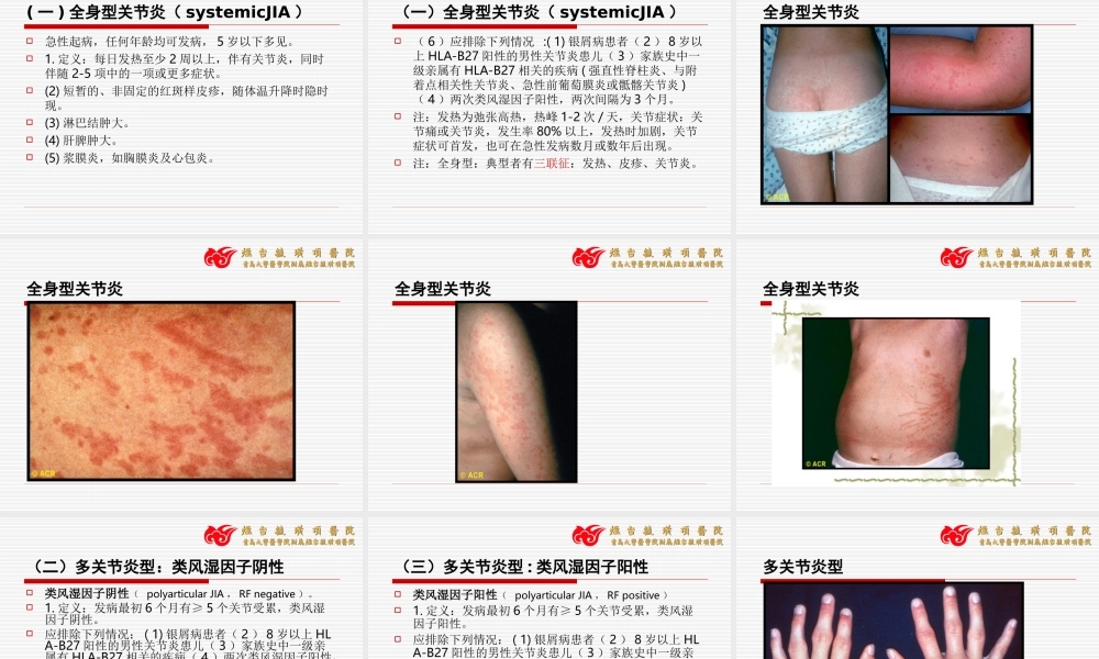 幼年类风湿关节炎13-14.ppt