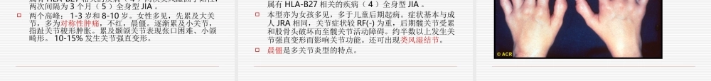 幼年类风湿关节炎13-14.ppt
