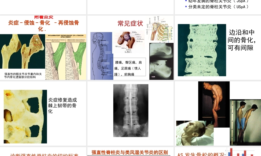 强直性脊柱炎与骨质疏松.pptx