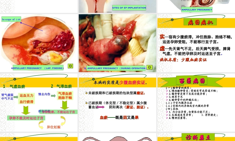 异位妊娠ppt.ppt