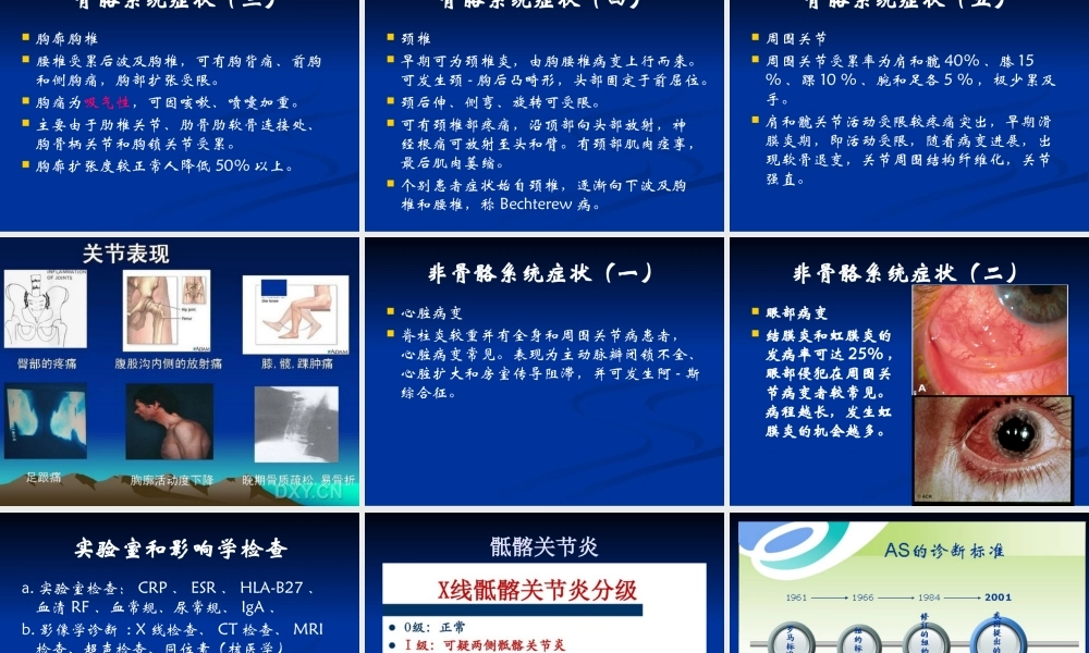强直性脊柱炎.pptx