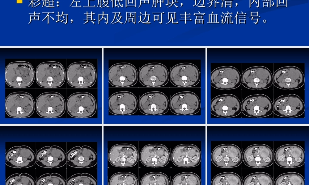 影像读片-巨淋巴结增.ppt