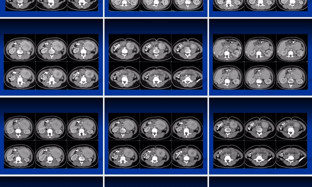 影像读片-巨淋巴结增.ppt