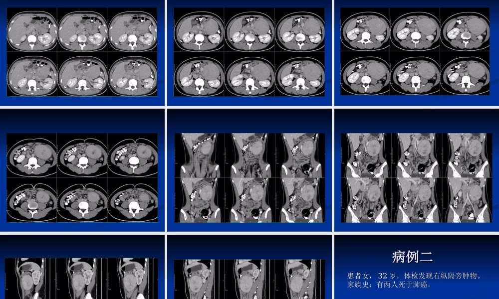 影像读片-巨淋巴结增.ppt