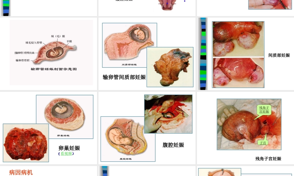 妊娠病异位妊娠.ppt
