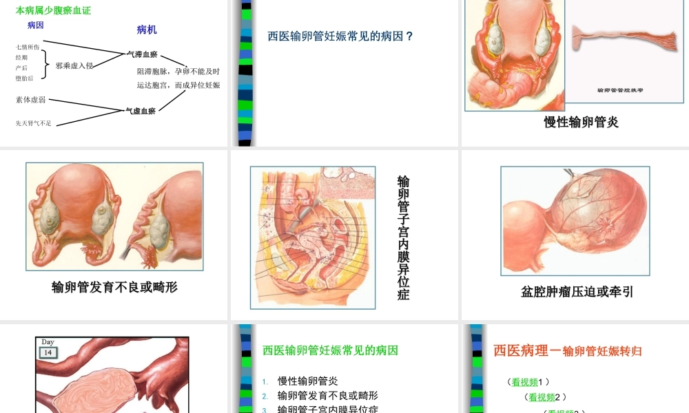 妊娠病异位妊娠.ppt