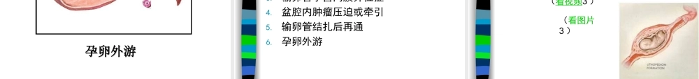 妊娠病异位妊娠.ppt