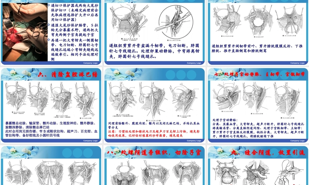 子宫内膜癌的手术配合.pptx