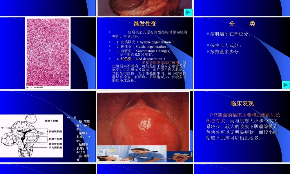 子宫肌瘤.ppt