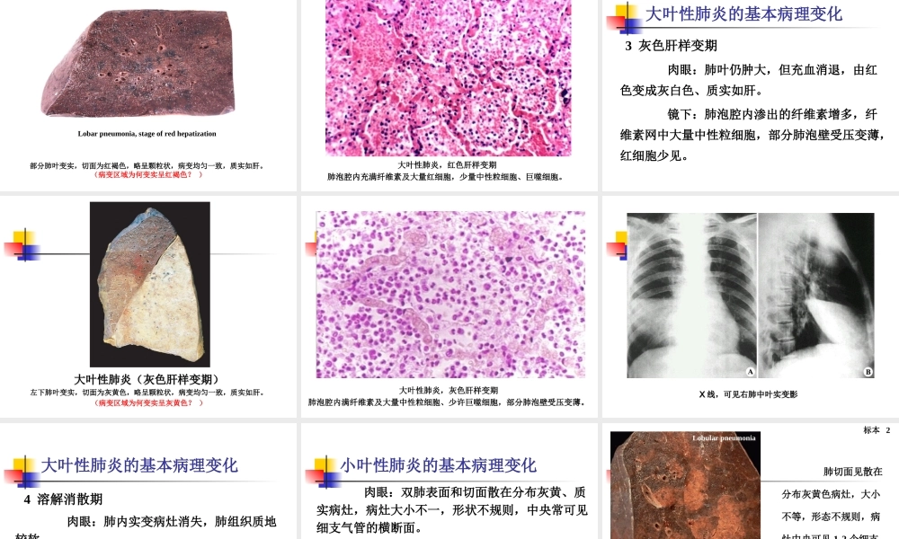 实习10-慢支炎、肺气肿、肺心病、肺炎.ppt