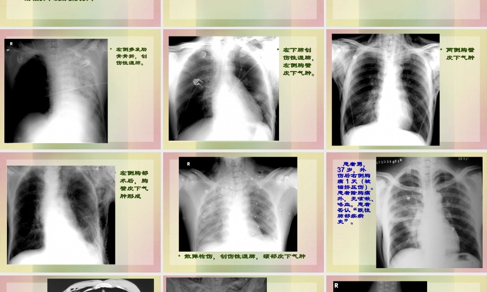 影像学-胸部外伤.ppt