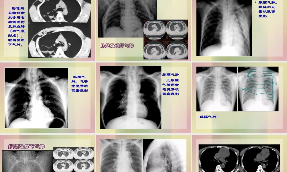 影像学-胸部外伤.ppt