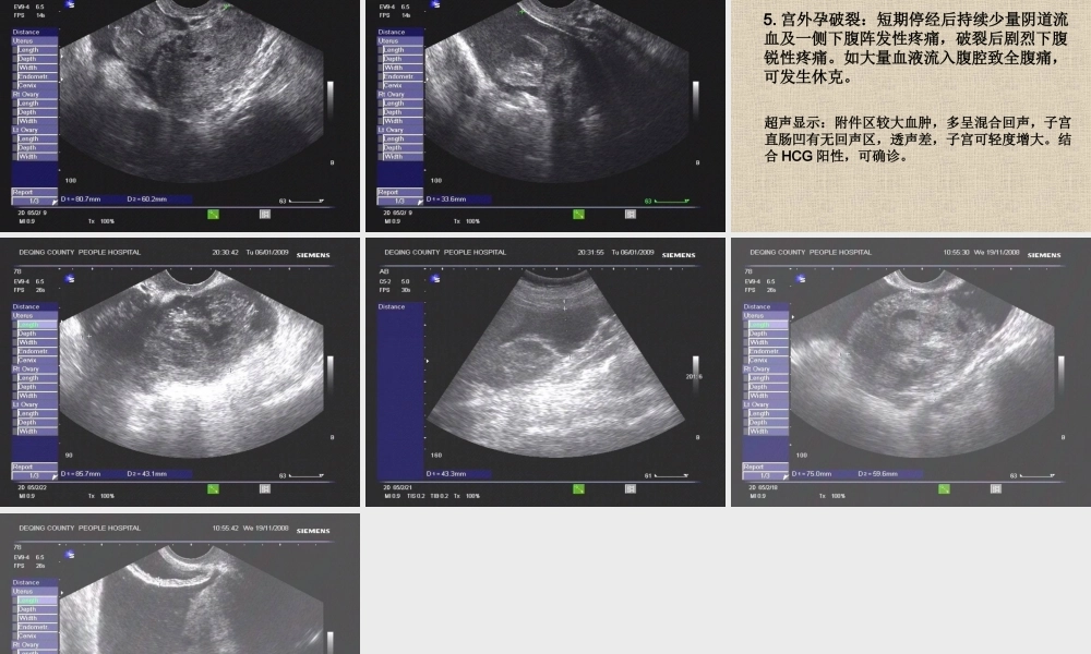 妇科常见急腹症.ppt