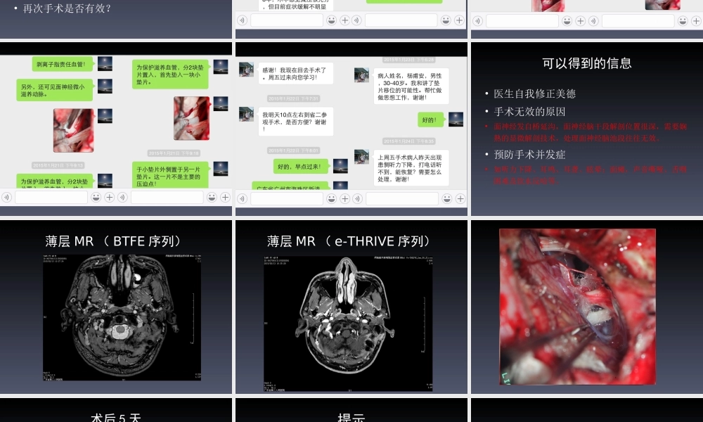 张勇医生(神经外科主任)讲解面肌痉挛.ppt