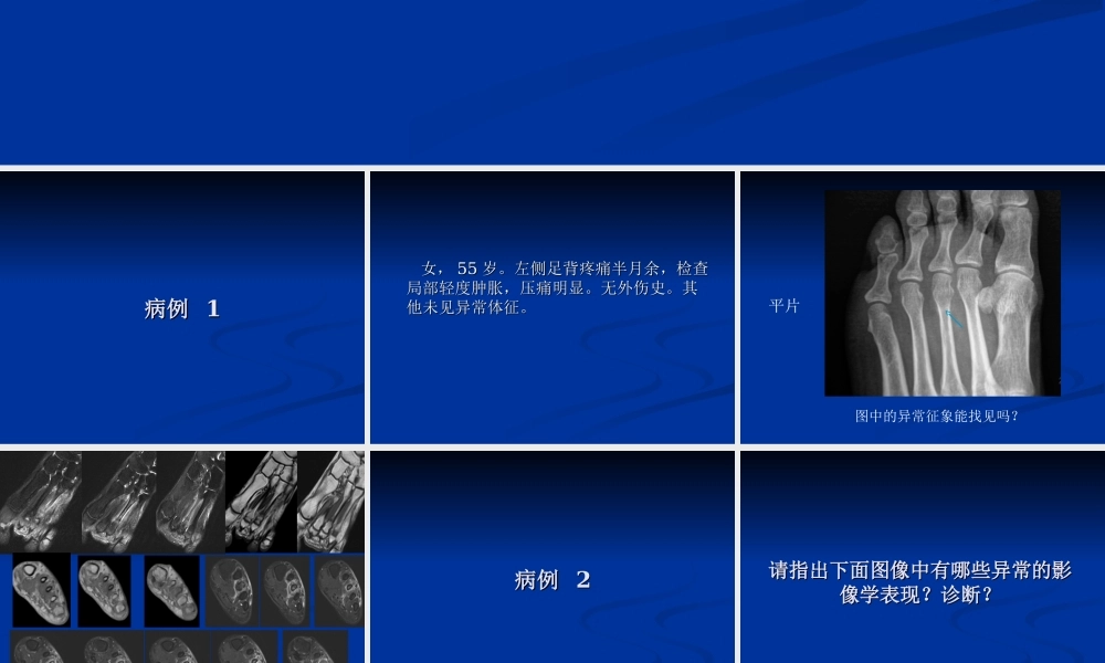 影像学病例读片-应力性骨折.ppt