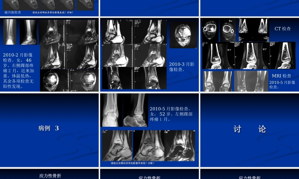 影像学病例读片-应力性骨折.ppt