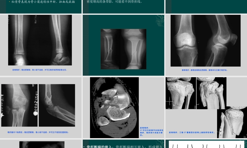 医科大学影像——骨2剖析.ppt
