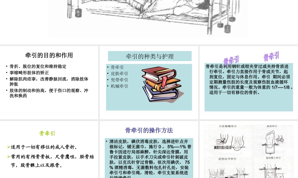 如小儿股骨干骨折用垂直悬吊皮牵引.ppt