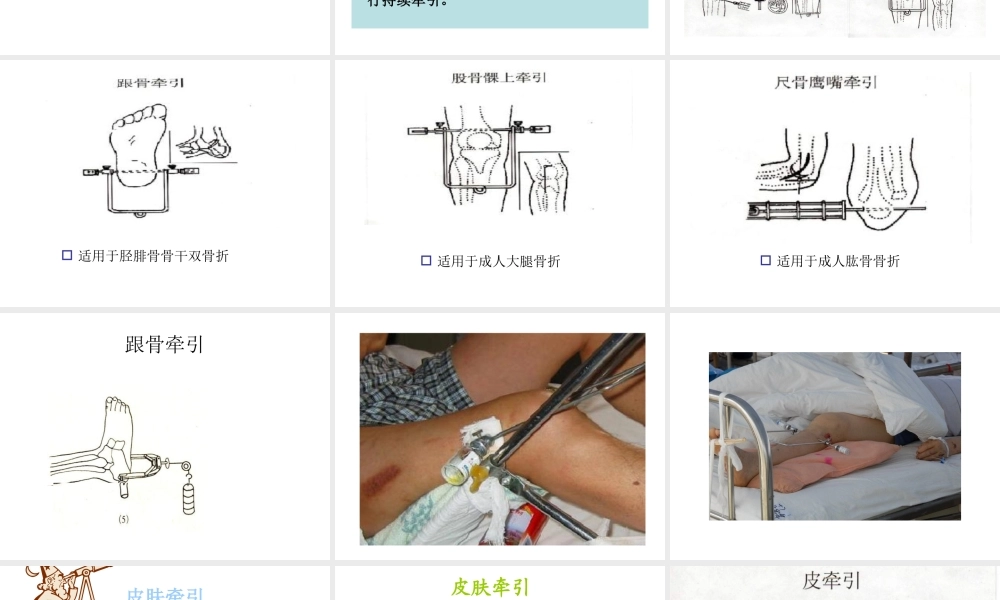 如小儿股骨干骨折用垂直悬吊皮牵引.ppt