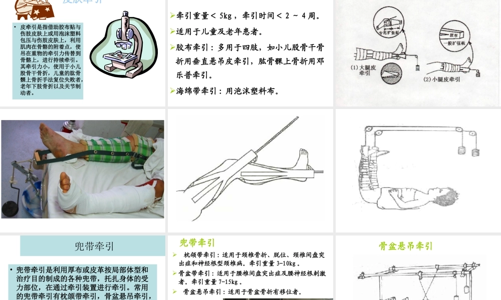 如小儿股骨干骨折用垂直悬吊皮牵引.ppt