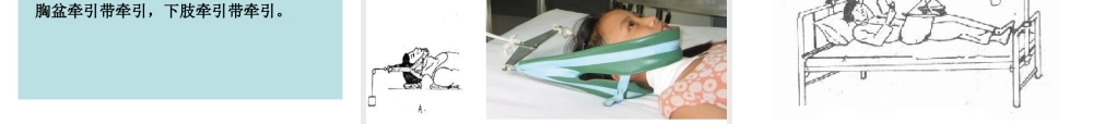 如小儿股骨干骨折用垂直悬吊皮牵引.ppt
