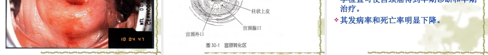 宫颈癌-PPT模板.ppt