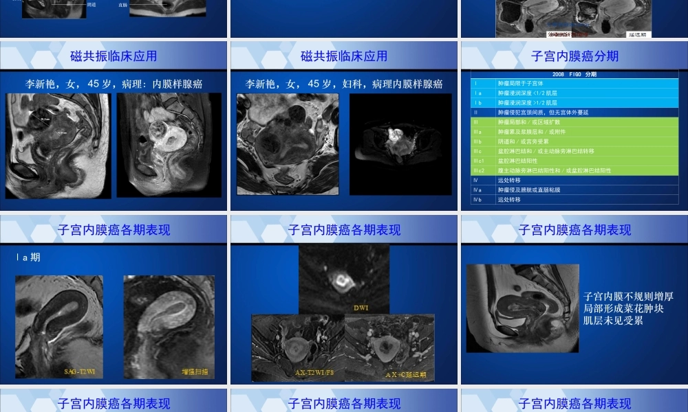 子宫内膜癌的MRI表现.ppt