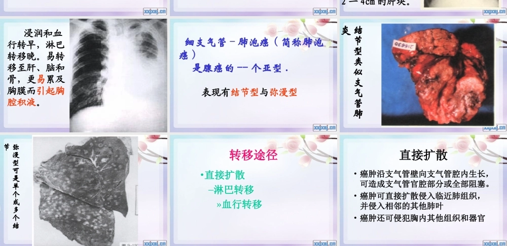 原发支气管肺癌1.ppt